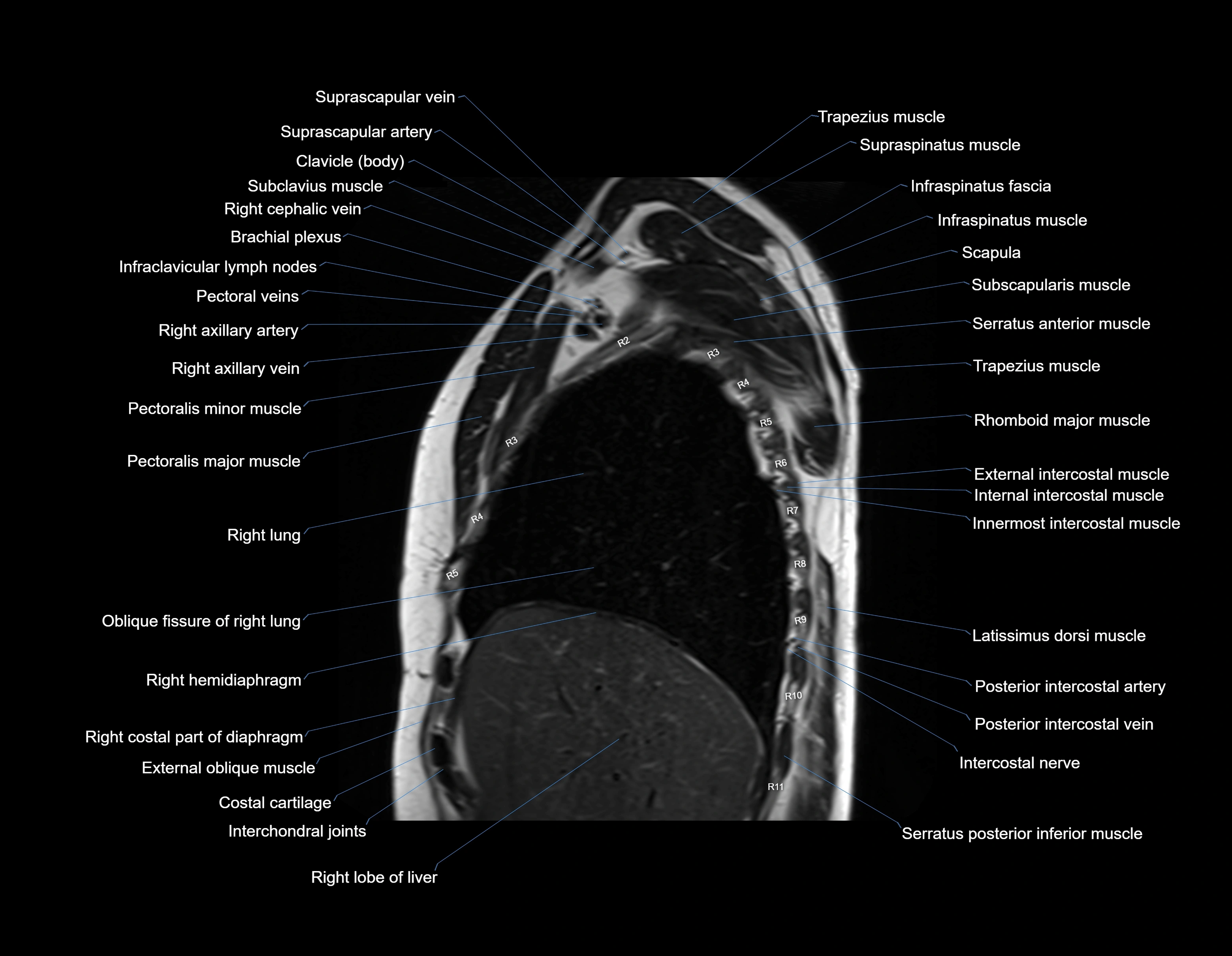 MRI chest (thorax) sagittal labelled cross sectional anatomy 3T radiology image-img-00001-00009.webp
